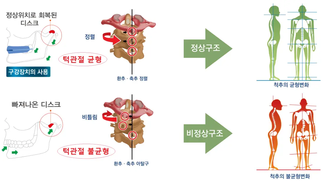턱관절 균형 치료 - 치료 원리 5
