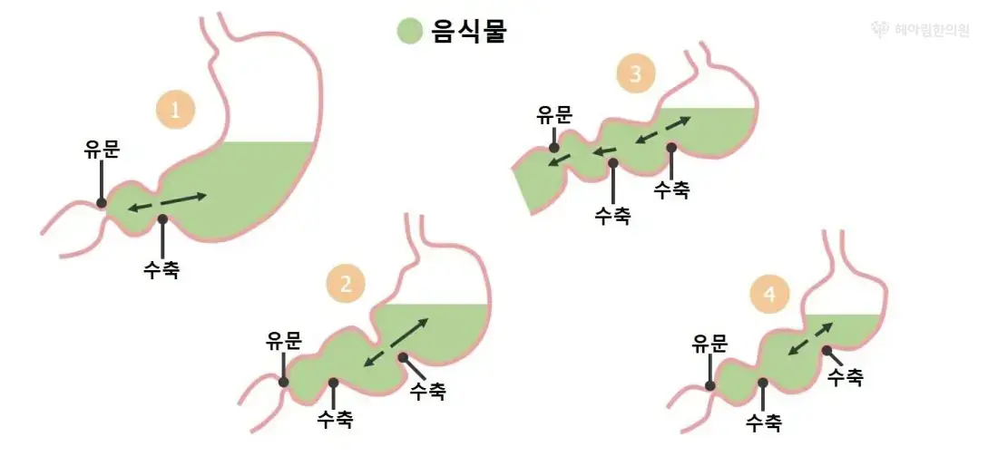 만성위장 치료 - 담적 (위가 굳어 안 움직임)