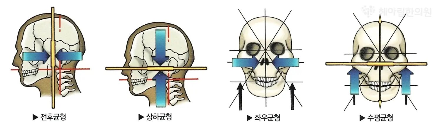 턱관절 균형 치료 - 치료 원리