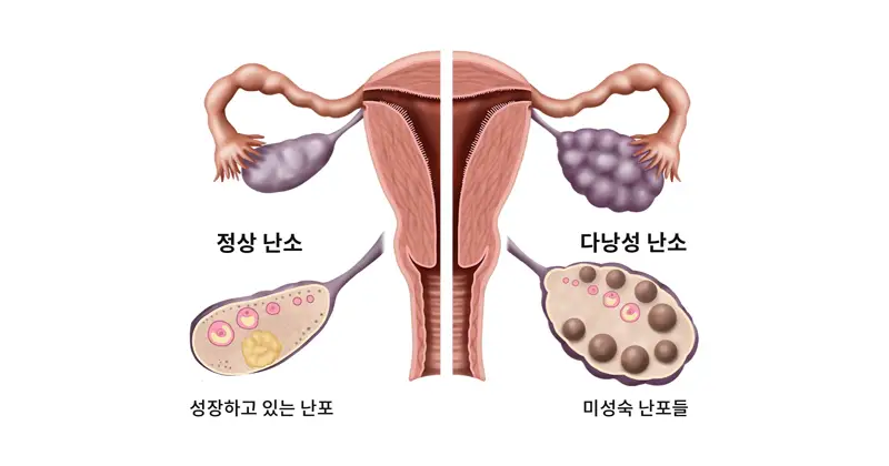 여성 부인과 치료 - (Polycystic Ovary Syndrome, PCOS)