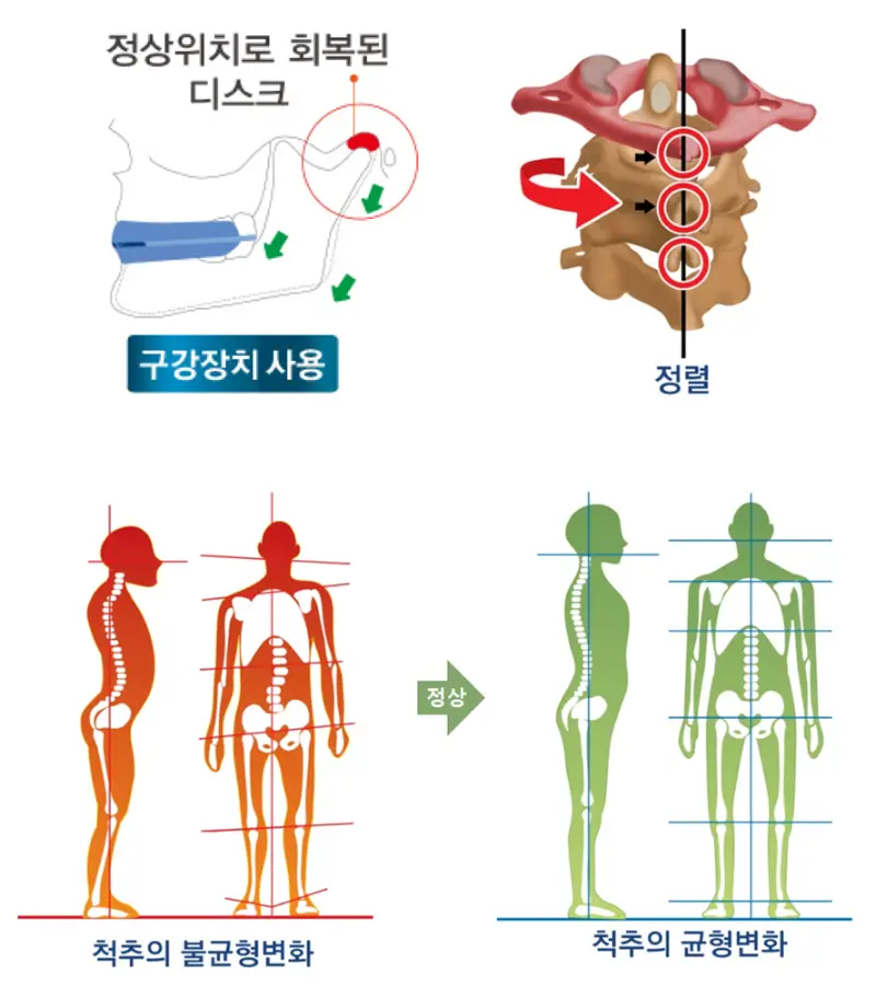 턱관절 균형 치료 - 치료 원리 6